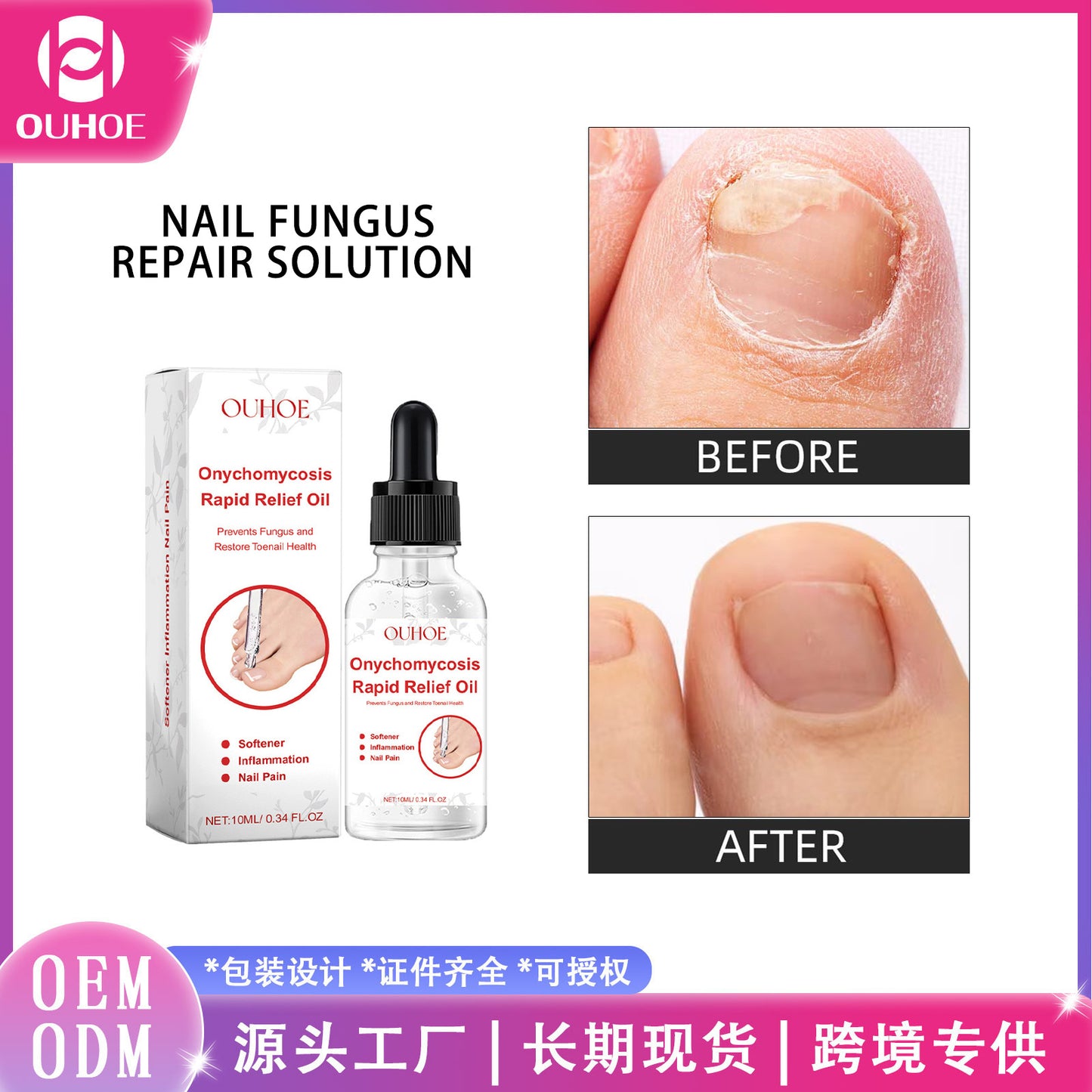 OUHOE Onychomycosis Repair Liquid Foot Care Moisturizing Cleansing Anti-Barb Onychomycosis Repair Nourishing Liquid